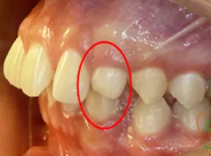 Scopri di più sull'articolo Canino Incluso Palatale