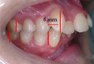 Estrazione dei quarti lato dx con Ingranaggio sbagliato di 6 mm
