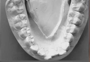 Estrazione dei quarti calco pavimento orale con affollamento notevole superiore