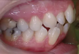 Estrazione dei quarti lato dx con lievissimo affollamento