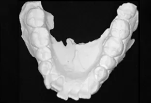 Estrazione dei quarti calco pavimento orale con lievissimo affollamento