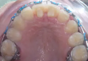 Estrazione dei quarti vista palato con apparecchio