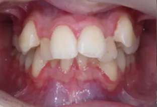 Estrazione dei quarti vista frontale con ingranaggio sbagliato di 6 mm