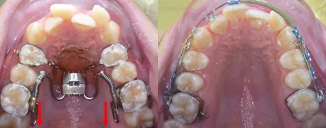 Estrazione dei quarti con apparecchio spostamento molari
