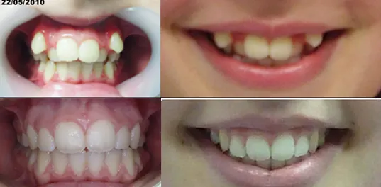 Estrazione dei quarti prima e dopo terapia