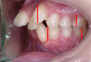 Estrazione dei quarti lato sx con ingranaggio sbagliato di 6 mm