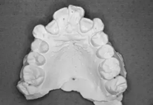 Estrazione dei quarti calco con ingranaggio sbagliato di 6 mm vista palato