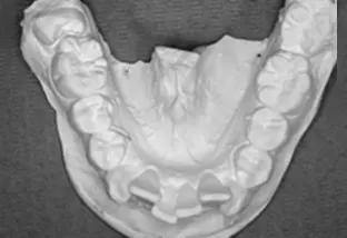Estrazione dei quarti calco con ingranaggio sbagliato di 6 mm pavimento orale