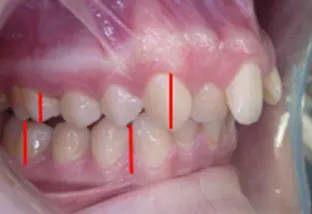 Estrazione dei quarti lato dx con affollamento notevole superiore