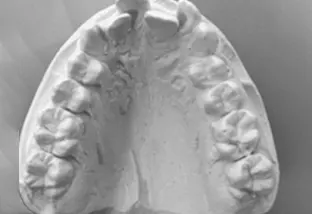 Estrazione dei quarti calco palato con affollamento notevole superiore