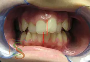 affollamento dentale