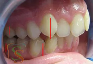 affollamento dentale fase iniziale vista dx