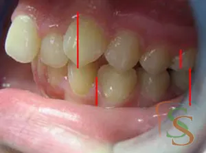 affollamento dentale fase iniziale vista sx