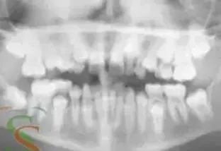 Agenesia dei laterali