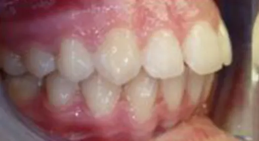 Denti allineati lato dx e Cubo di Rubik