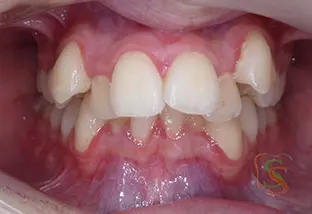 Denti disallineati vista frontale