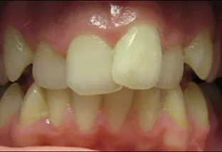 Denti disallineati vista frontale e Cubo di Rubik
