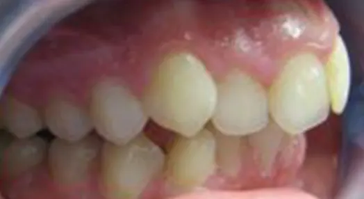 Denti disallineati lato dx e Cubo di Rubik