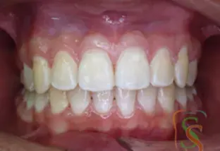 Scopri di più sull'articolo La II classe dentale