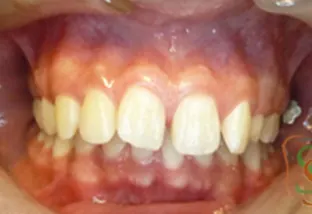 la seconda classe dentale vista frontale iniziale