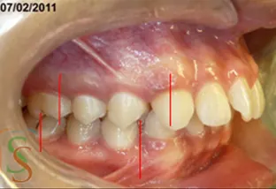 la seconda classe dentale lato dx iniziale