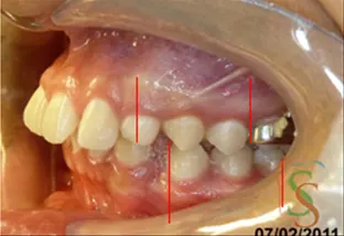 la seconda classe dentale lato sx iniziale