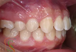 la seconda classe dentale lato dx finale