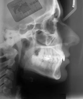 Teleradiografia latero-laterale del cranio