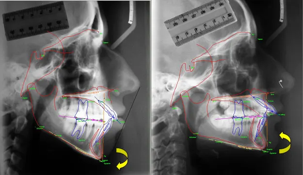 Teleradiografia e relazione denti con le basi ossee