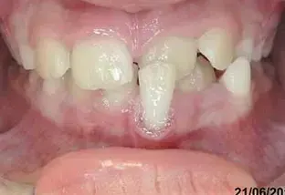 Scopri di più sull'articolo La fusione dentale e il dente bigemino
