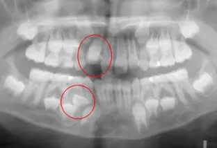 Scopri di più sull'articolo I denti sovrannumerari