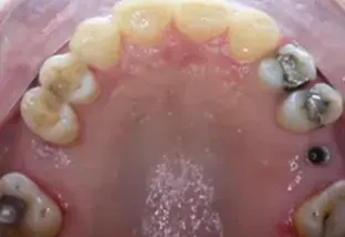 Scopri di più sull'articolo il trauma occlusale