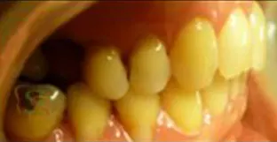 Il trauma occlusale fase trattamento ortodontico vista laterale dx