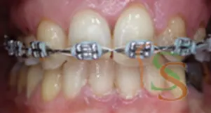 Il trauma occlusale fase trattamento ortodontico vista frontale