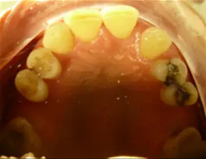 Il trauma occlusale fase trattamento ortodontico
