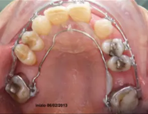 Il trauma occlusale fase trattamento ortodontico
