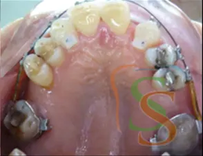 Il trauma occlusale fase trattamento ortodontico