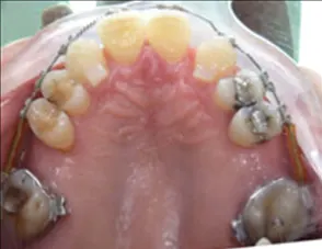 Il trauma occlusale fase trattamento ortodontico