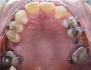Il trauma occlusale fase trattamento ortodontico