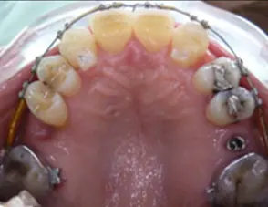 Il trauma occlusale fase trattamento ortodontico