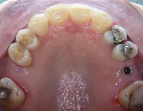 Il trauma occlusale fase trattamento ortodontico