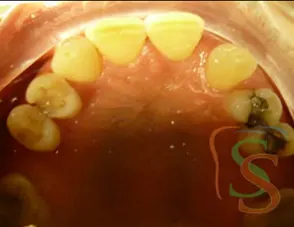 Il trauma occlusale fase trattamento ortodontico