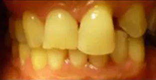 Il trauma occlusale fase trattamento ortodontico vista frontale