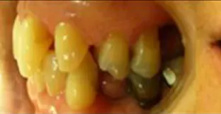 Il trauma occlusale fase trattamento ortodontico vista laterale sx