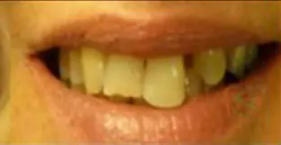 Il trauma occlusale fase trattamento ortodontico vista frontale