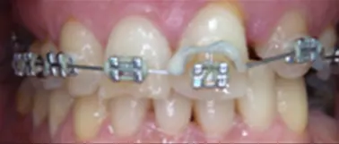 Il trauma occlusale fase trattamento ortodontico vista frontale