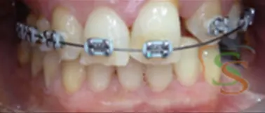 Il trauma occlusale fase trattamento ortodontico vista frontale