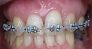 Il trauma occlusale fase trattamento ortodontico vista frontale