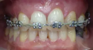 Il trauma occlusale fase trattamento ortodontico vista frontale