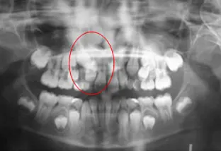 Scopri di più sull'articolo OPT (orto pan tomografia)
